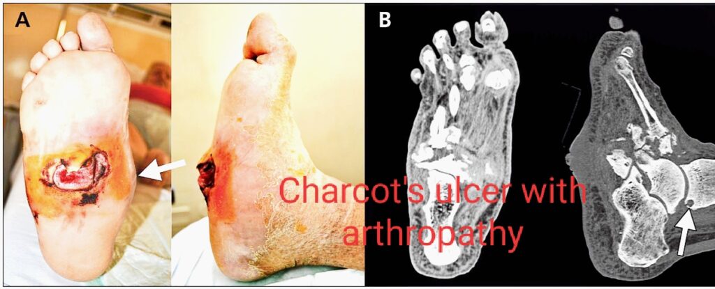 Charcot foot And Diabetes