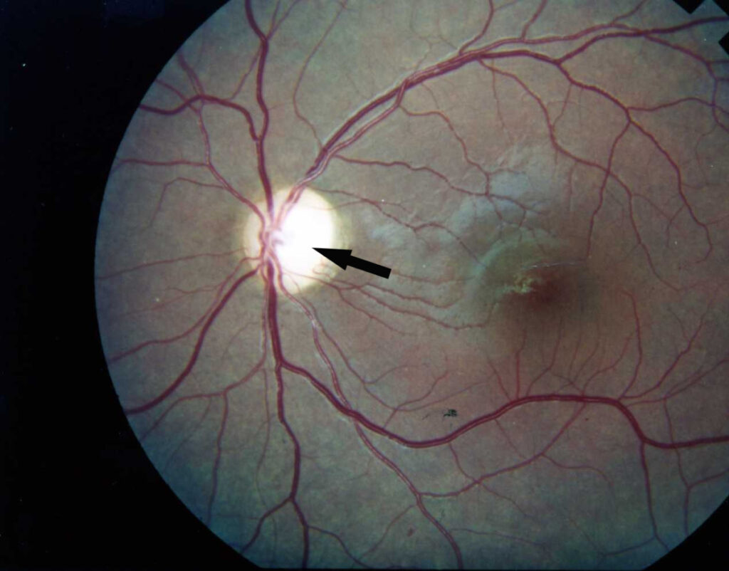 Diabetic retinopathy symptoms treatment complications