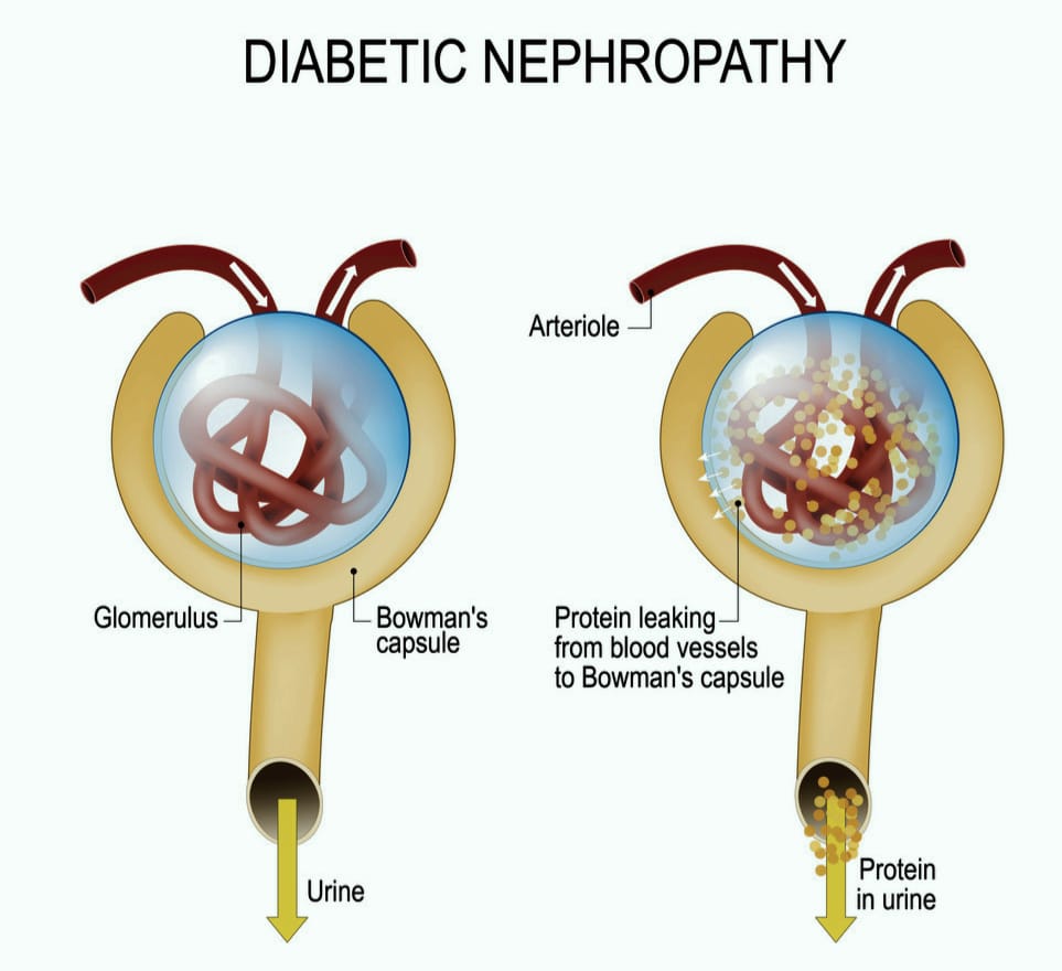 How Does Diabetes Cause Nephropathy Pathophysiology