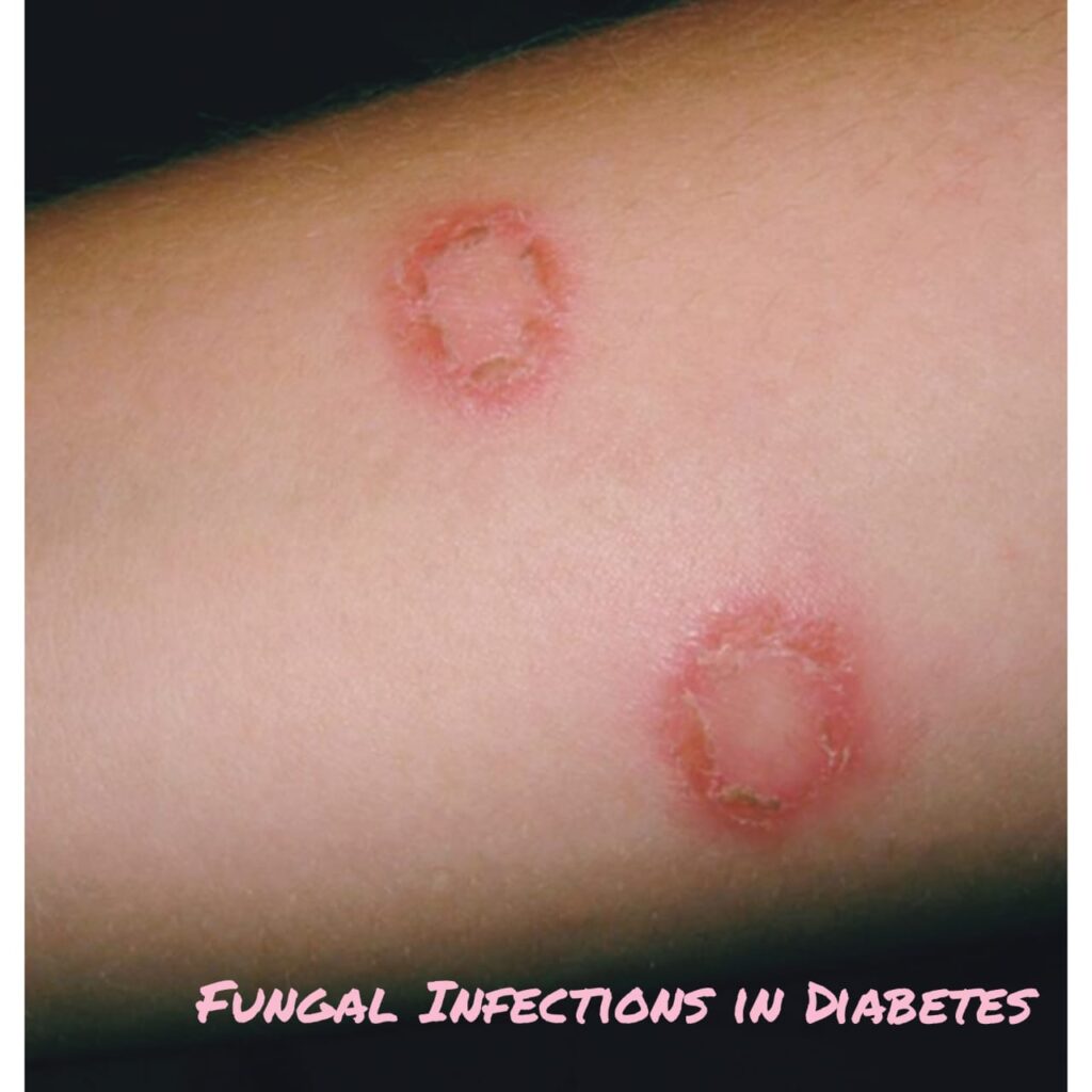 fungal infection in diabetes