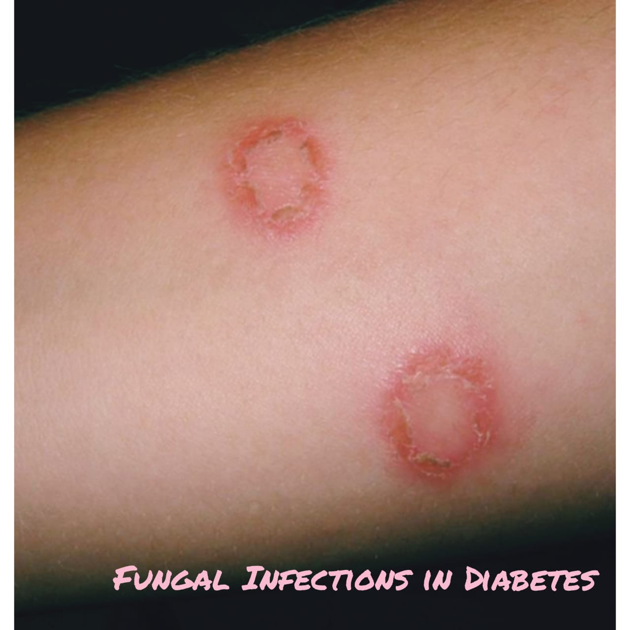 Fungal Infections - Dr Ben Medical - Men's Health Singapore GP Clinic