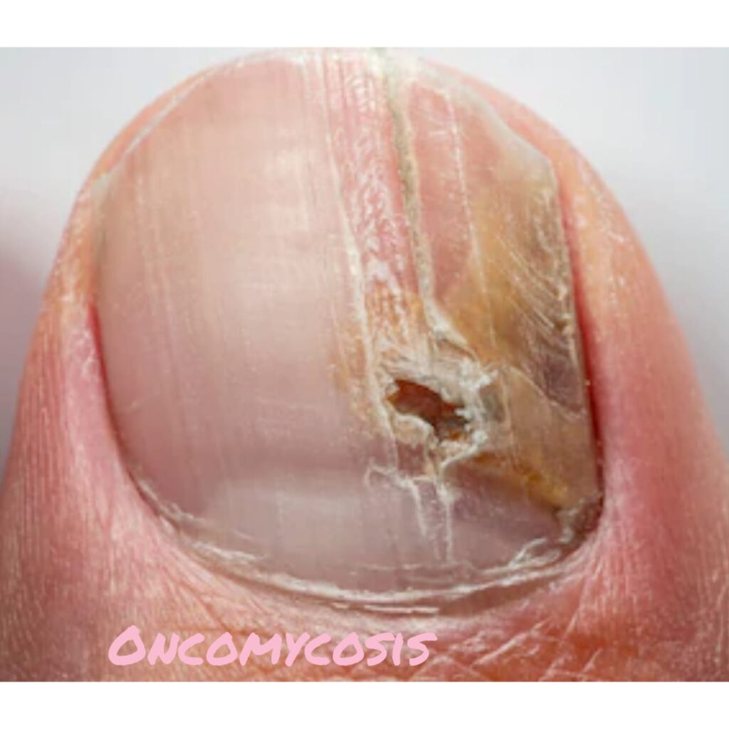 diabetes and nail infection