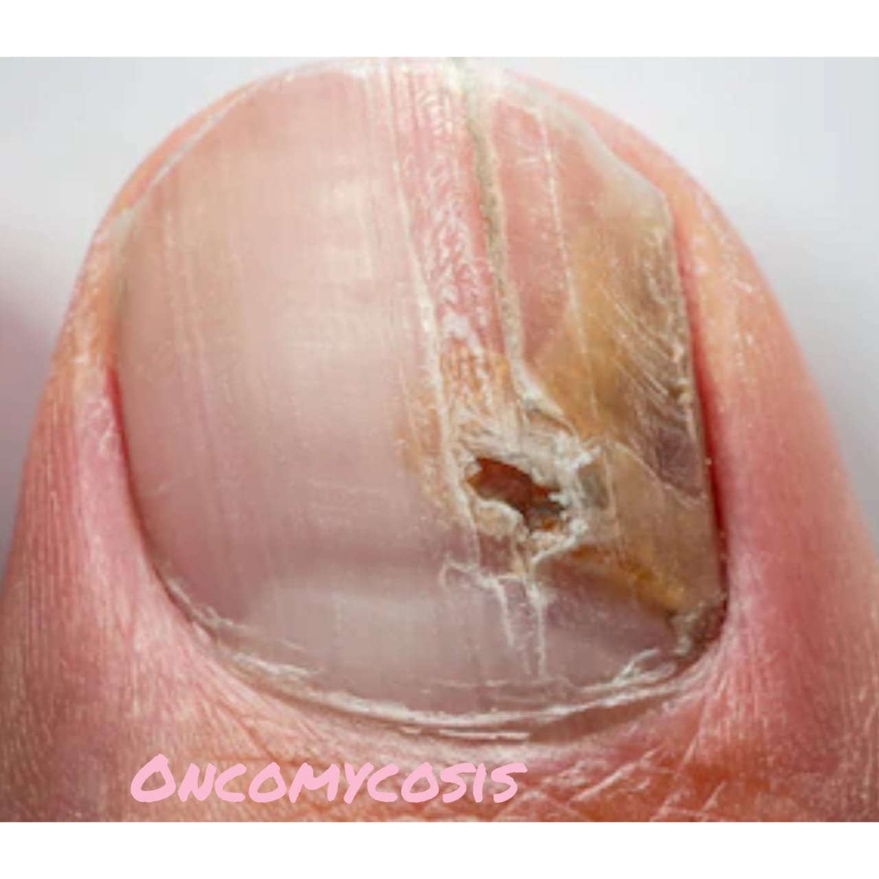 Best medication for nail fungus: Types and benefits